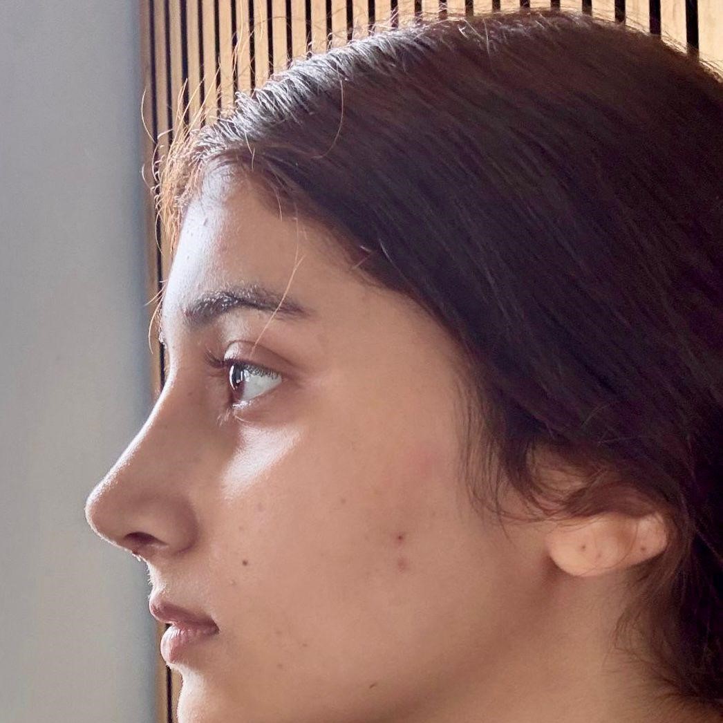 After rhinoplasty