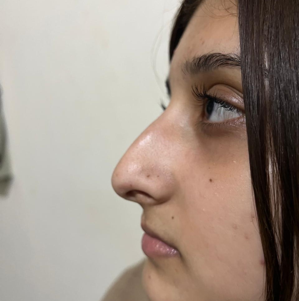 Before rhinoplasty